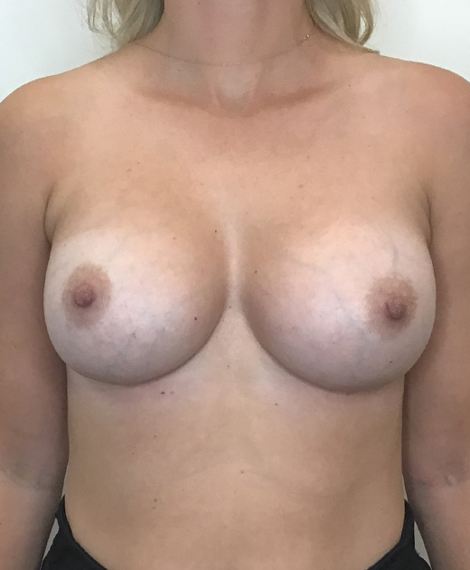 Breast Implant Revision Before and After | CIARAVINO Plastic Surgery & Med Spa
