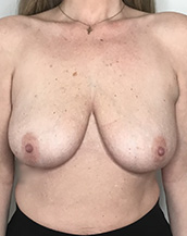 Breast Lift With Implants Before and After | CIARAVINO Plastic Surgery & Med Spa