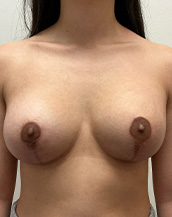 Breast Lift With Implants Before and After | CIARAVINO Plastic Surgery & Med Spa