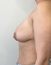 Breast Lift With Implants Before and After | CIARAVINO Plastic Surgery & Med Spa