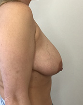 Breast Lift With Implants Before and After | CIARAVINO Plastic Surgery & Med Spa