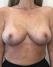 Breast Lift With Implants Before and After | CIARAVINO Plastic Surgery & Med Spa