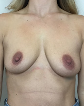 Breast Lift With Implants Before and After | CIARAVINO Plastic Surgery & Med Spa