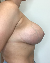 Breast Lift With Implants Before and After | CIARAVINO Plastic Surgery & Med Spa