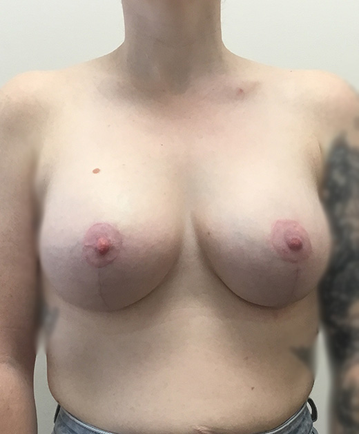 Breast Lift With Implants Before and After | CIARAVINO Plastic Surgery & Med Spa