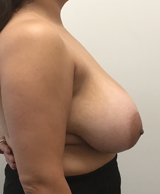 Breast Reduction Before and After | CIARAVINO Plastic Surgery & Med Spa
