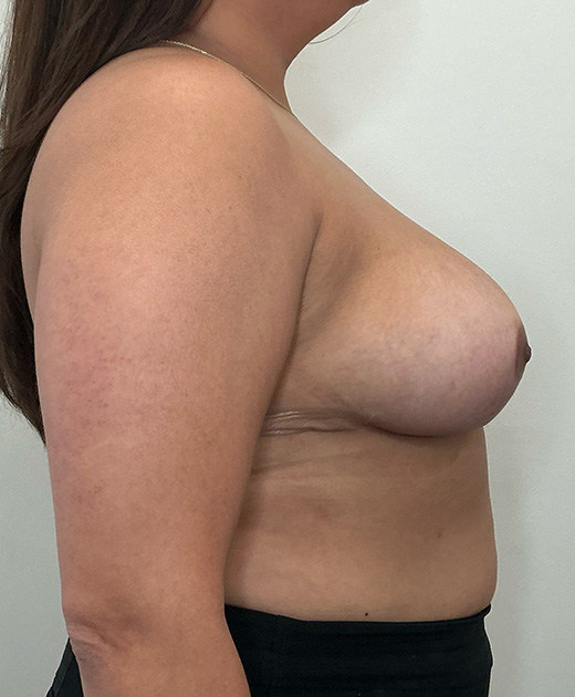 Breast Reduction Before and After | CIARAVINO Plastic Surgery & Med Spa