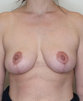 Breast Reduction Before and After | CIARAVINO Plastic Surgery & Med Spa