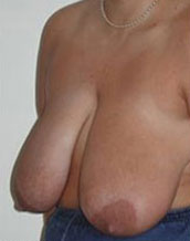 Breast Reduction Before and After | CIARAVINO Plastic Surgery & Med Spa