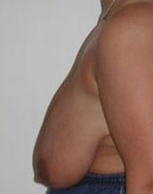 Breast Reduction Before and After | CIARAVINO Plastic Surgery & Med Spa