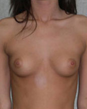 Breast Augmentation Saline Implants Before and After | CIARAVINO Plastic Surgery