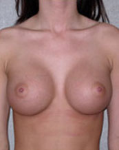 Breast Augmentation Saline Implants Before and After | CIARAVINO Plastic Surgery