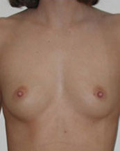 Breast Augmentation Saline Implants Before and After | CIARAVINO Plastic Surgery