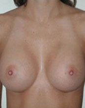 Breast Augmentation Saline Implants Before and After | CIARAVINO Plastic Surgery