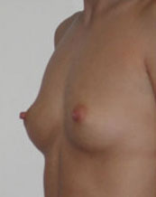 Breast Augmentation Saline Implants Before and After | CIARAVINO Plastic Surgery