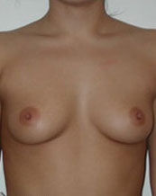 Breast Augmentation Saline Implants Before and After | CIARAVINO Plastic Surgery