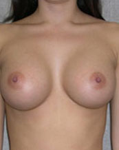 Breast Augmentation Saline Implants Before and After | CIARAVINO Plastic Surgery