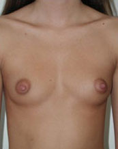 Breast Augmentation Saline Implants Before and After | CIARAVINO Plastic Surgery