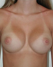 Breast Augmentation Saline Implants Before and After | CIARAVINO Plastic Surgery