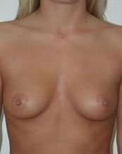 Breast Augmentation Saline Implants Before and After | CIARAVINO Plastic Surgery