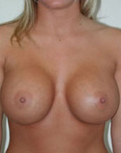 Breast Augmentation Saline Implants Before and After | CIARAVINO Plastic Surgery