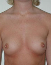 Breast Augmentation Saline Implants Before and After | CIARAVINO Plastic Surgery