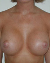 Breast Augmentation Saline Implants Before and After | CIARAVINO Plastic Surgery