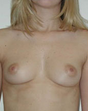 Breast Augmentation Saline Implants Before and After | CIARAVINO Plastic Surgery