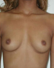 Breast Augmentation Saline Implants Before and After | CIARAVINO Plastic Surgery