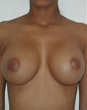 Breast Augmentation Saline Implants Before and After | CIARAVINO Plastic Surgery