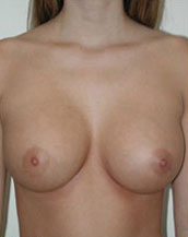 Breast Augmentation Saline Implants Before and After | CIARAVINO Plastic Surgery