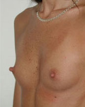 Breast Augmentation Saline Implants Before and After | CIARAVINO Plastic Surgery