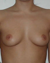 Breast Augmentation Saline Implants Before and After | CIARAVINO Plastic Surgery