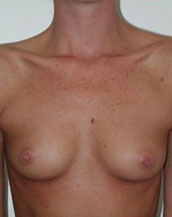 Breast Augmentation Saline Implants Before and After | CIARAVINO Plastic Surgery