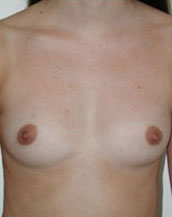 Breast Augmentation Saline Implants Before and After | CIARAVINO Plastic Surgery