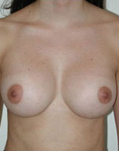 Breast Augmentation Saline Implants Before and After | CIARAVINO Plastic Surgery