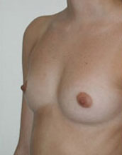 Breast Augmentation Saline Implants Before and After | CIARAVINO Plastic Surgery