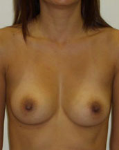 Breast Augmentation Saline Implants Before and After | CIARAVINO Plastic Surgery