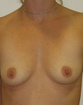 Breast Augmentation Saline Implants Before and After | CIARAVINO Plastic Surgery