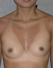 Breast Augmentation Saline Implants Before and After | CIARAVINO Plastic Surgery