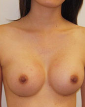 Breast Augmentation Saline Implants Before and After | CIARAVINO Plastic Surgery