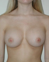 Breast Augmentation Saline Implants Before and After | CIARAVINO Plastic Surgery