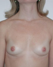 Breast Augmentation Saline Implants Before and After | CIARAVINO Plastic Surgery