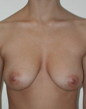 Breast Augmentation Saline Implants Before and After | CIARAVINO Plastic Surgery