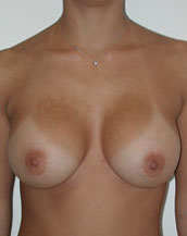 Breast Augmentation Saline Implants Before and After | CIARAVINO Plastic Surgery