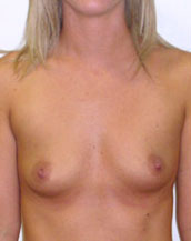 Breast Augmentation Saline Implants Before and After | CIARAVINO Plastic Surgery