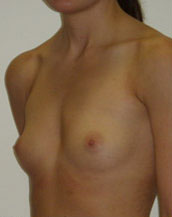 Breast Augmentation Saline Implants Before and After | CIARAVINO Plastic Surgery