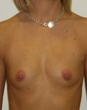 Breast Augmentation Saline Implants Before and After | CIARAVINO Plastic Surgery