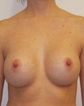 Breast Augmentation Saline Implants Before and After | CIARAVINO Plastic Surgery