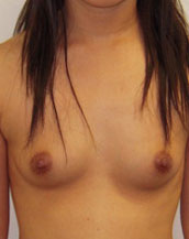 Breast Augmentation Saline Implants Before and After | CIARAVINO Plastic Surgery